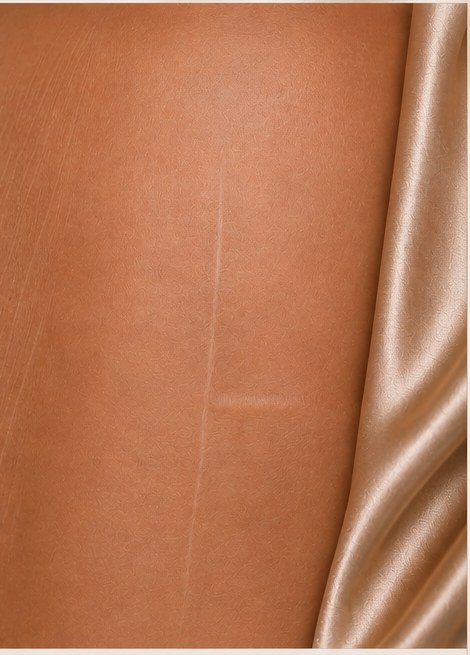 Bikini area after 10 sessions