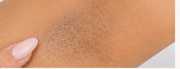 Underarms before treatment